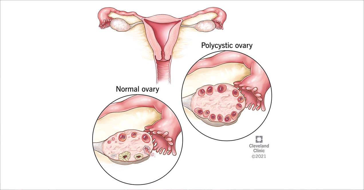 Empowering Women: Understanding and Managing PCOS
